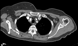 Takayasu's Arteritis of Arch Branches Especially Left Subclavian - CTisus CT Scan