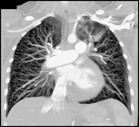 Metastatic Thyroid Cancer With Miliary Nodules - CTisus CT Scan