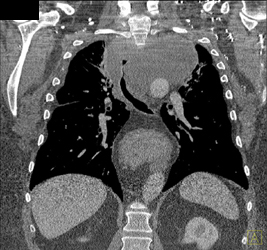 Goiter Narrows Airway - CTisus CT Scan