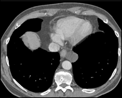 Bronchogenic Cyst - CTisus CT Scan