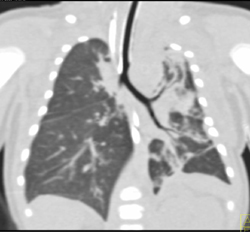 Patent Airway With Left Upper Lobe Atelectasis - CTisus CT Scan