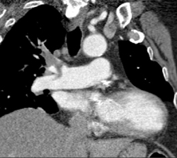 Pulmonary Embolism - CTisus CT Scan