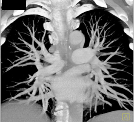 Pulmonary Embolism - CTisus CT Scan