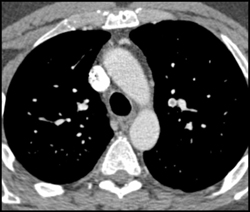 Pulmonary Embolism - CTisus CT Scan