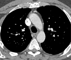 Pulmonary Embolism - CTisus CT Scan