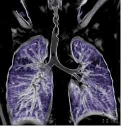 Narrowing of Trachea Due to Trauma - CTisus CT Scan