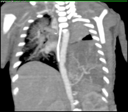 Sequestration - CTisus CT Scan