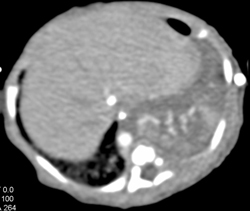 Sequestration - CTisus CT Scan