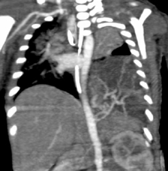 Sequestration - CTisus CT Scan