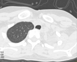 Wegener's Occludes Left Mainstem Bronchi - CTisus CT Scan