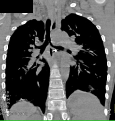 Tracheal Stenosis With Virtual Bronchoscopy - CTisus CT Scan