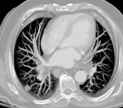 Pulmonary Arteriovenous Malformation (PAVM) - CTisus CT Scan