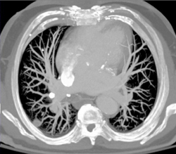 Pulmonary Arteriovenous Malformation (PAVM) - CTisus CT Scan