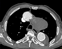 Endovascular Stent in Thoracic Aneurysm - CTisus CT Scan