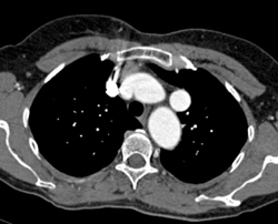 Dilated Branch Vessels Off Arch - CTisus CT Scan