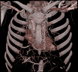 Collaterals in Internal Mammary Artery - CTisus CT Scan