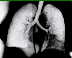 Right Upper Lobe Nodule and Infiltrate Left Lower Lobe - CTisus CT Scan