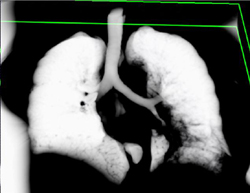 Lung Cancer Encases the Left Lower Lobe Bronchus - CTisus CT Scan