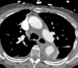 Ulceration Aorta With Intramural Hematoma - CTisus CT Scan