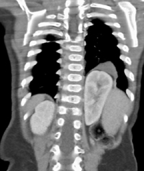 Sequestration - CTisus CT Scan