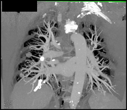 Pulmonary Arteriovenous Malformations (PAVMs) - CTisus CT Scan