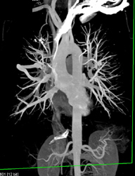 Pulmonary Arteriovenous Malformation (PAVM) - CTisus CT Scan