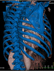 Pulmonary Arteriovenous Malformation (PAVM) - CTisus CT Scan