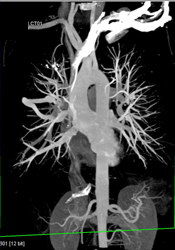 Pulmonary Arteriovenous Malformation (PAVM) - CTisus CT Scan