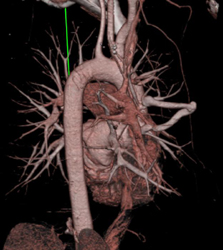 Pulmonary Arteriovenous Malformation (PAVM) - CTisus CT Scan