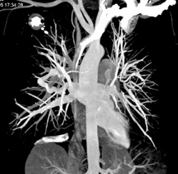 Pulmonary Arteriovenous Malformation (PAVM) - CTisus CT Scan