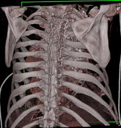 Collaterals Along Spine - CTisus CT Scan