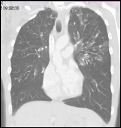 Infection and Bronchiectasis - CTisus CT Scan