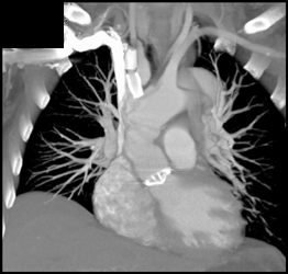 Patent Stent in Right Subclavian Artery - CTisus CT Scan