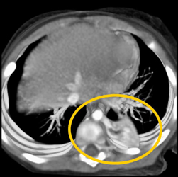 Left Lower Lobe Sequestration - CTisus CT Scan