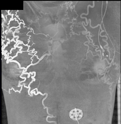 SVC Occlusion and Collaterals - CTisus CT Scan