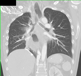 Stent in Lt Mainstem Bronchus - CTisus CT Scan