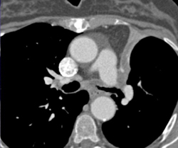 Wegener's Granulomatosis Invades the Left Upper Lobe Bronchus With Collapse. Note How This Simulates A Neoplasm - CTisus CT Scan