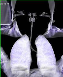 Narrow Trachea in Child - CTisus CT Scan