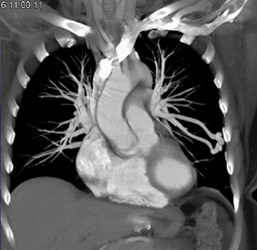 Pulmonary Arteriovenous Malformation (PAVM) - CTisus CT Scan