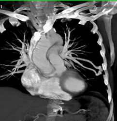 Pulmonary Arteriovenous Malformation (PAVM) - CTisus CT Scan