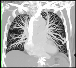 Pulmonary Arteriovenous Malformation (PAVM) - CTisus CT Scan