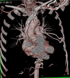 Pulmonary Arteriovenous Malformation (PAVM) - CTisus CT Scan