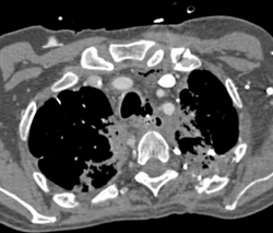 Te Fistulae in Mediastinum - CTisus CT Scan