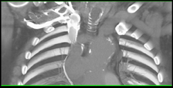 SVC Occlusion With Collaterals - CTisus CT Scan