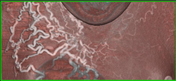 SVC Occlusion With Collaterals - CTisus CT Scan