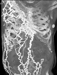 SVC Occlusion With Collaterals - CTisus CT Scan