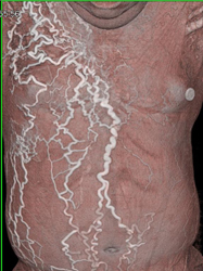 SVC Occlusion With Collaterals - CTisus CT Scan