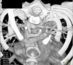 Aortic Ring - CTisus CT Scan