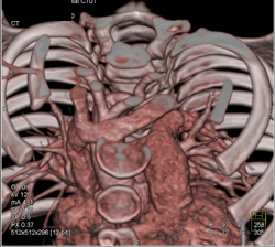 Rt Arch With Ring - CTisus CT Scan