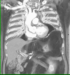 Liposarcoma Extends Through Diaphragm - CTisus CT Scan